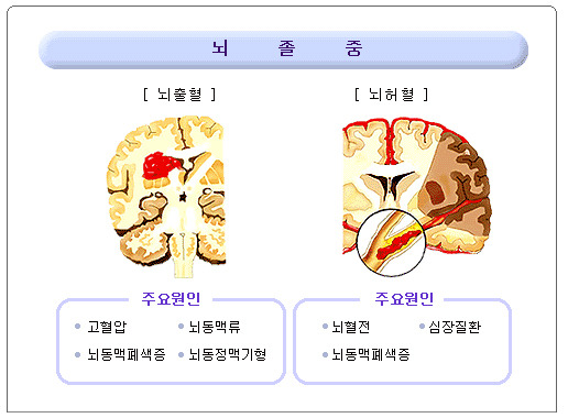 뇌졸중